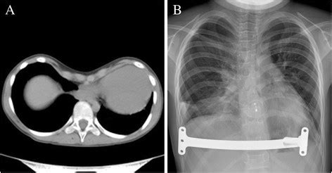 Imaging of the pectus excavatum. (A) CT showing the severe asymmetric ...