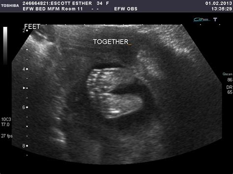 Nine Months of Baby: 18 Week Ultrasound Boy or Girl?