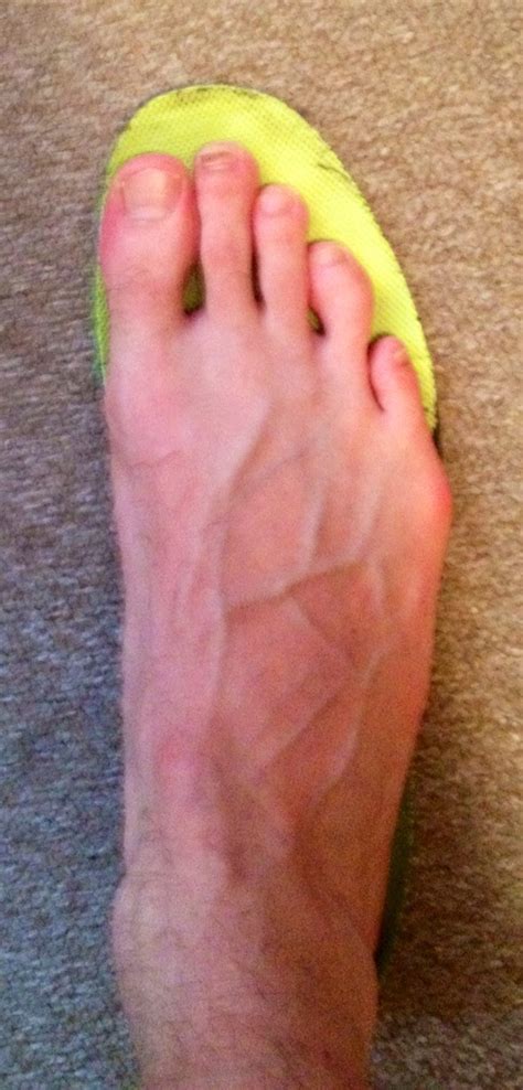 Running blisters - treatment and prevention