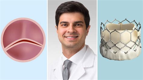 Bicuspid Aortic Valves: Surgical & Transcatheter Aortic Valve Replacement Options for Patients ...