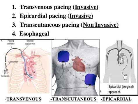 Pin by nonas arc on Epicardial pacing wires | Catheter, Jugular, Context