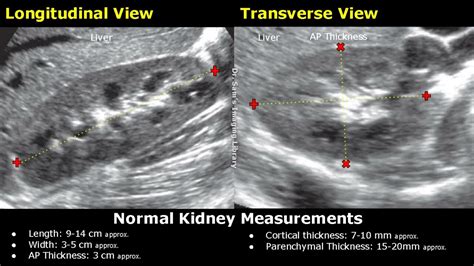 Normal Pediatric Renal Ultrasound