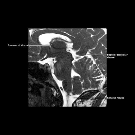 Subarachnoid Spaces/Cisterns | Radiology Key