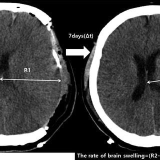 Axial brain CT scan showing brain swelling on postoperative day 7. The... | Download Scientific ...