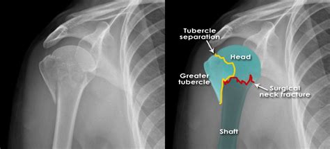 Anatomical Neck Fracture Humerus