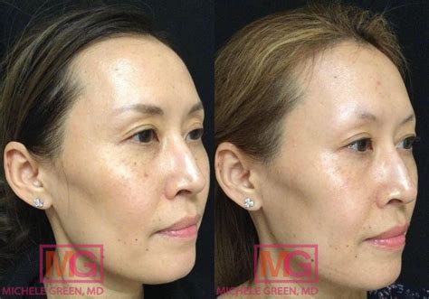 Sunspots Before & After Photos - Dr. Michele Green M.D.