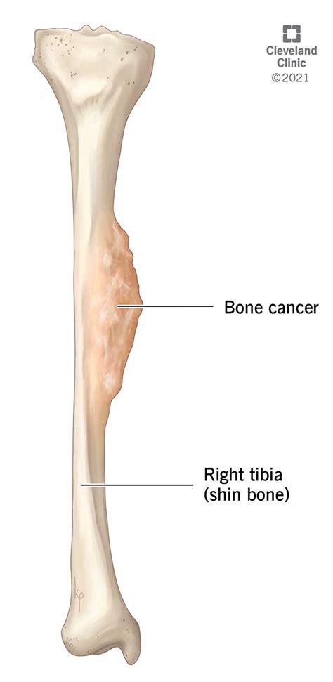 Bone Cancer: Symptoms, Signs, Treatment, Causes & Stages