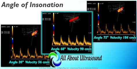 Mastering Doppler Principles and Hemodynamics