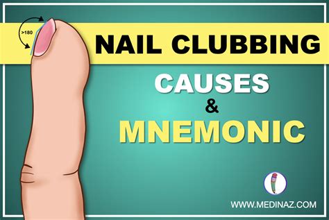 Nail Clubbing Causes & Mnemonic to Remember - Medinaz Blog