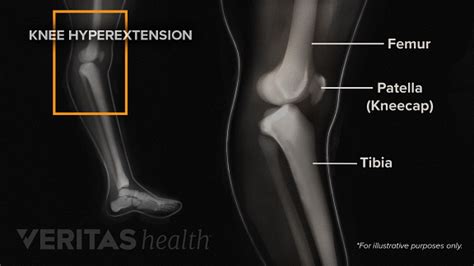 Diagnosing Knee Hyperextension