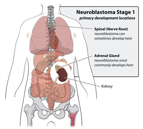 Childhood Neuroblastoma Cancer: Causes, Risk Factors, and Prevention - ACCO