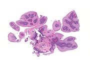 Squamous papilloma of the esophagus - Libre Pathology