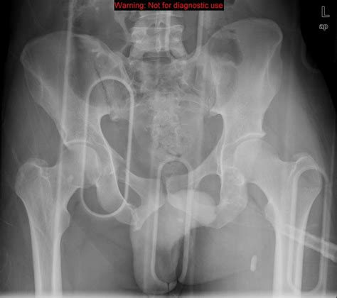 Malgaigne fracture is an unstable type of pelvic fracture, which involves one hemipelvis, and ...