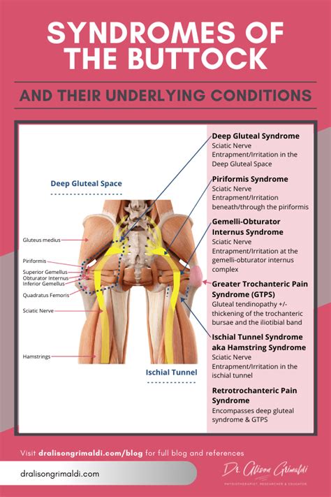 How many syndromes can a buttock have? - Dr Alison Grimaldi