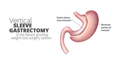 sleeve gastrectomy | Aloha Surgery | Weight Loss Surgery