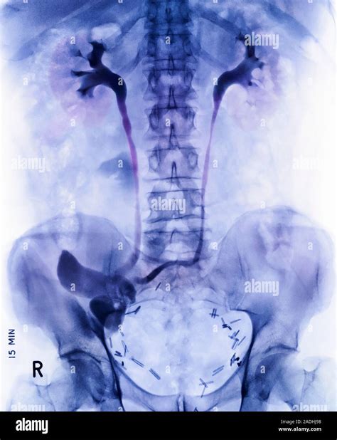 Ileal conduit surgery. Coloured frontal X-ray of a male patient shortly ...