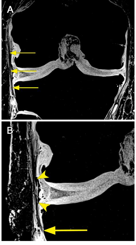 MRI in the coronal plane fully depicting the ALL which is shown as a ...