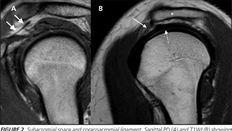 [PDF] Shoulder Impingement and Associated MRI Findings | Semantic Scholar