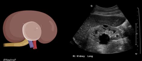 Parapelvic Cyst Ultrasound