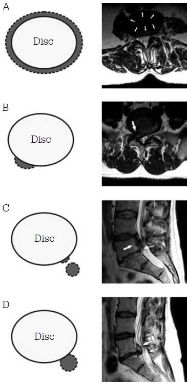 Lumbar Spine Mri Bulging Disc