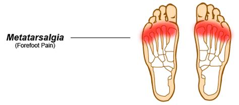 Metatarsalgia St. Catharines Ontario, Canadian Foot Clinic & Orthotic Centre