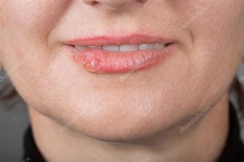 Lip infection with the herpes virus — Stock Photo © kopitin #88354690