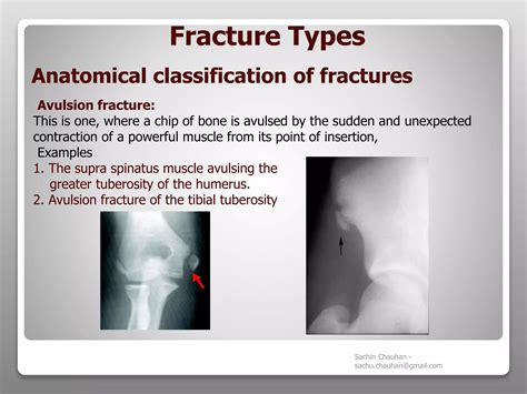 Fracture - Types, complications and management | PPT