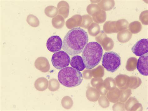 Acute myeloid leukemia. Causes, symptoms, treatment Acute myeloid leukemia