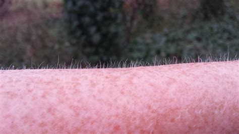 Goosebumps Skin Disease