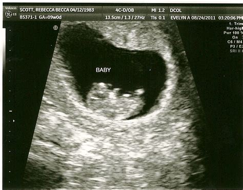 The Scotts: Baby Makes Three: First Ultrasound...9 weeks