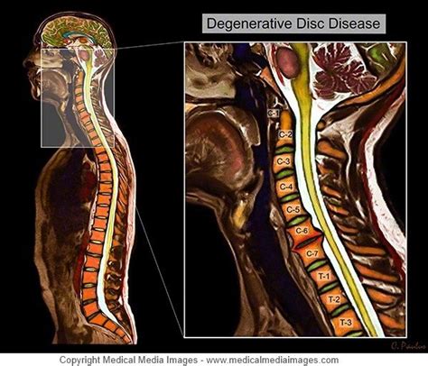 Color MRI of the Cervical Spine showing Degenerative Disc Disease (DDD). A novel, advanced ...