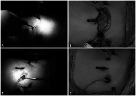 Procedures for extracorporeal ileal conduit urinary diversion. (A ...