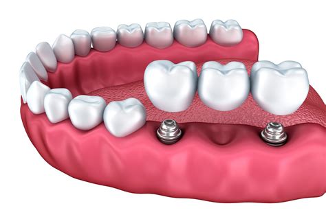 Implant-Supported Bridges - Wayland, MA - Bessler & Kang