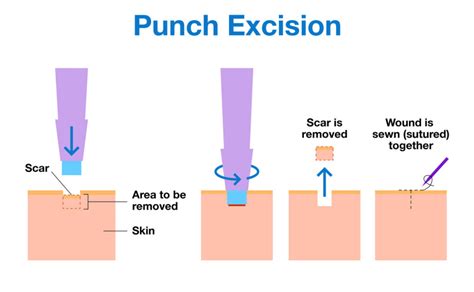 About - Acne.org