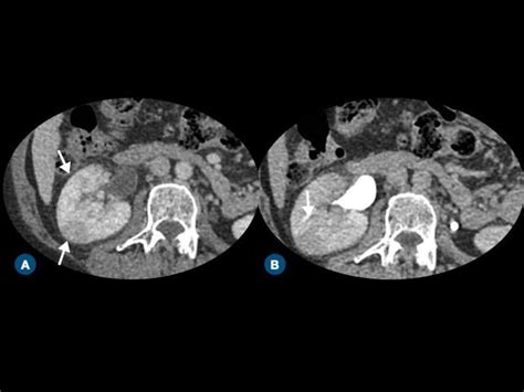 Acute pyelonephritis. Contrast-enhanced CT images on (A) nephrographic... | Download Scientific ...