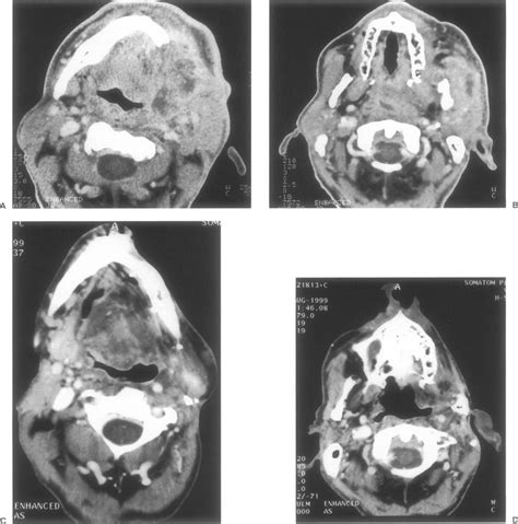 Preoperative CT scan of the mandible (A) and pterygoid region (B).... | Download Scientific Diagram