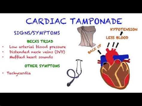 Cardiac Tamponade Symptoms