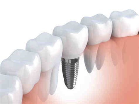 Cosmetic @ implant dentistry - Dental News Network