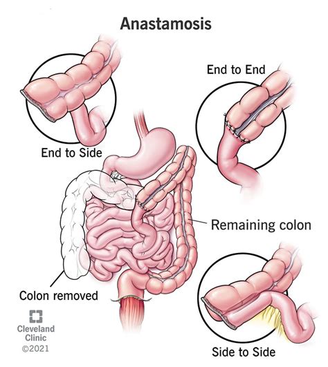 Anastomosis: Definition, Types & Procedure