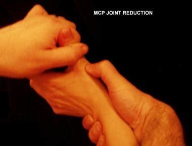 Reduction of Thumb Dislocation Technique: Approach Considerations, Thumb Joint Reduction ...