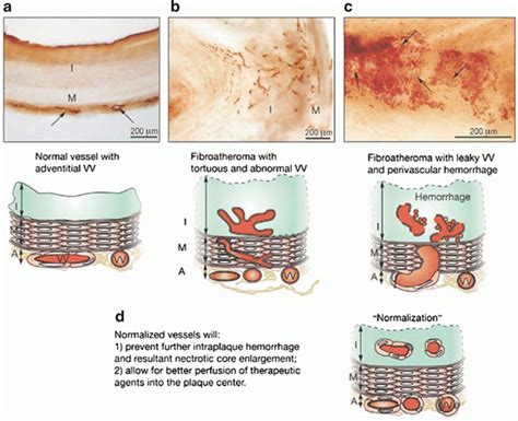 Molecular Imaging of Inflammation and Intraplaque Vasa Vasorum ...