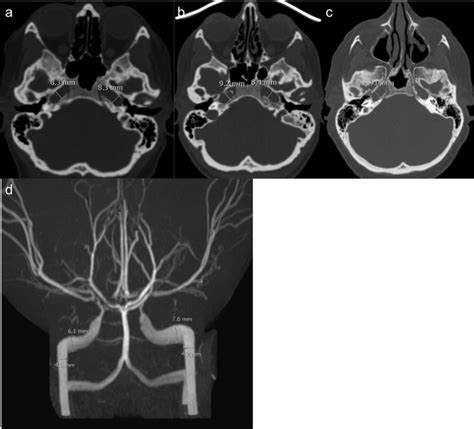 Axial CT scans showing measurements of the petrous carotid canal in the ...