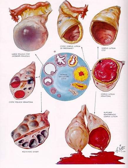 Complex Ovarian Cyst Symptoms