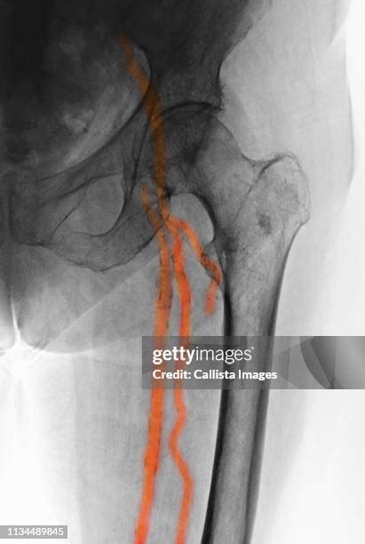 Calcified Arteries Photos and Premium High Res Pictures - Getty Images