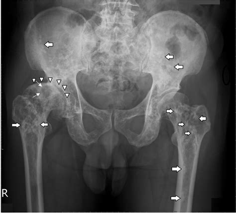 Plain radiography of pelvis. Multiple round and irregular radio-dense... | Download Scientific ...