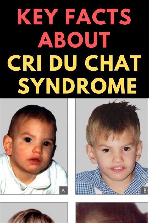 Cri Du Chat Syndrome – Interesting Facts, Causes, Symptoms, Treatment ...