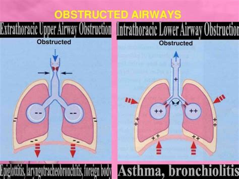 upper & lower airway obstruction