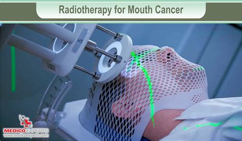 6 options for mouth cancer treatment without surgery