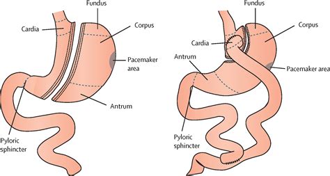 Adaptations in gastrointestinal physiology after sleeve gastrectomy and Roux-en-Y gastric bypass ...