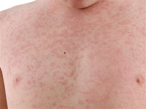 Rubella (German Measles): Symptoms, treatment, during pregnancy